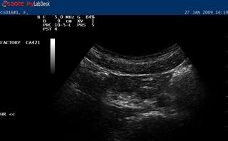 Ultrasound scan of the recutus abdominis muscle at rest